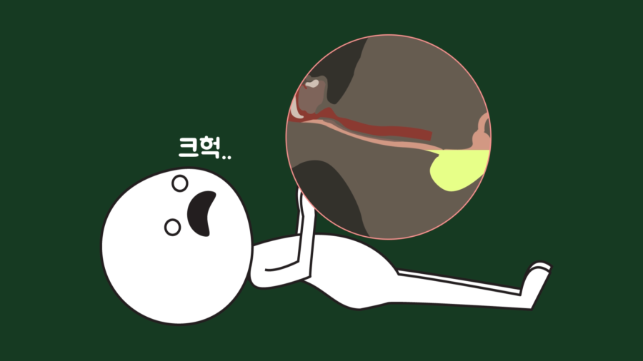 Gastroesophageal Reflux Disease 4