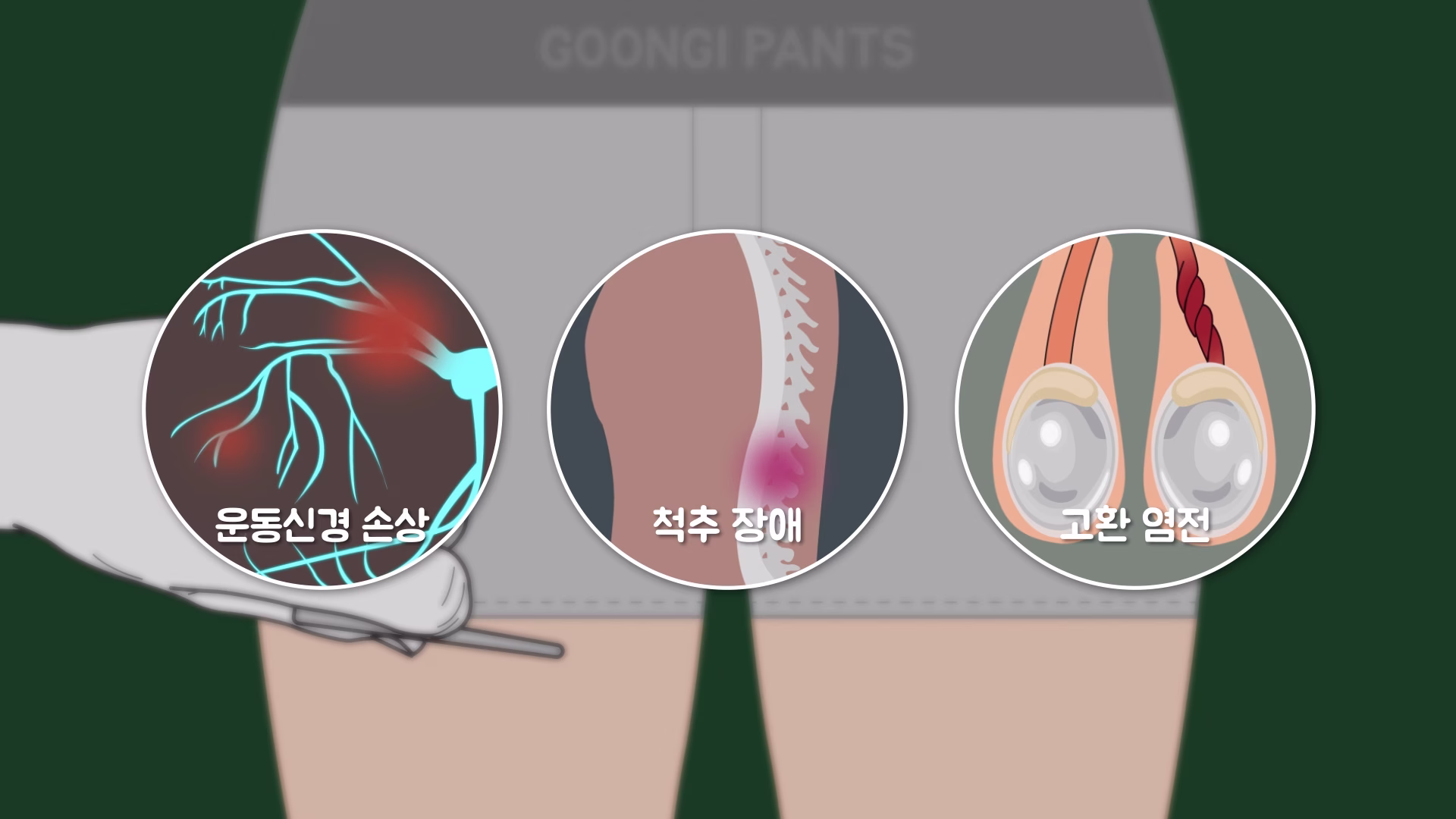 고환거근반사와 관련된 신경 및 고환 상태